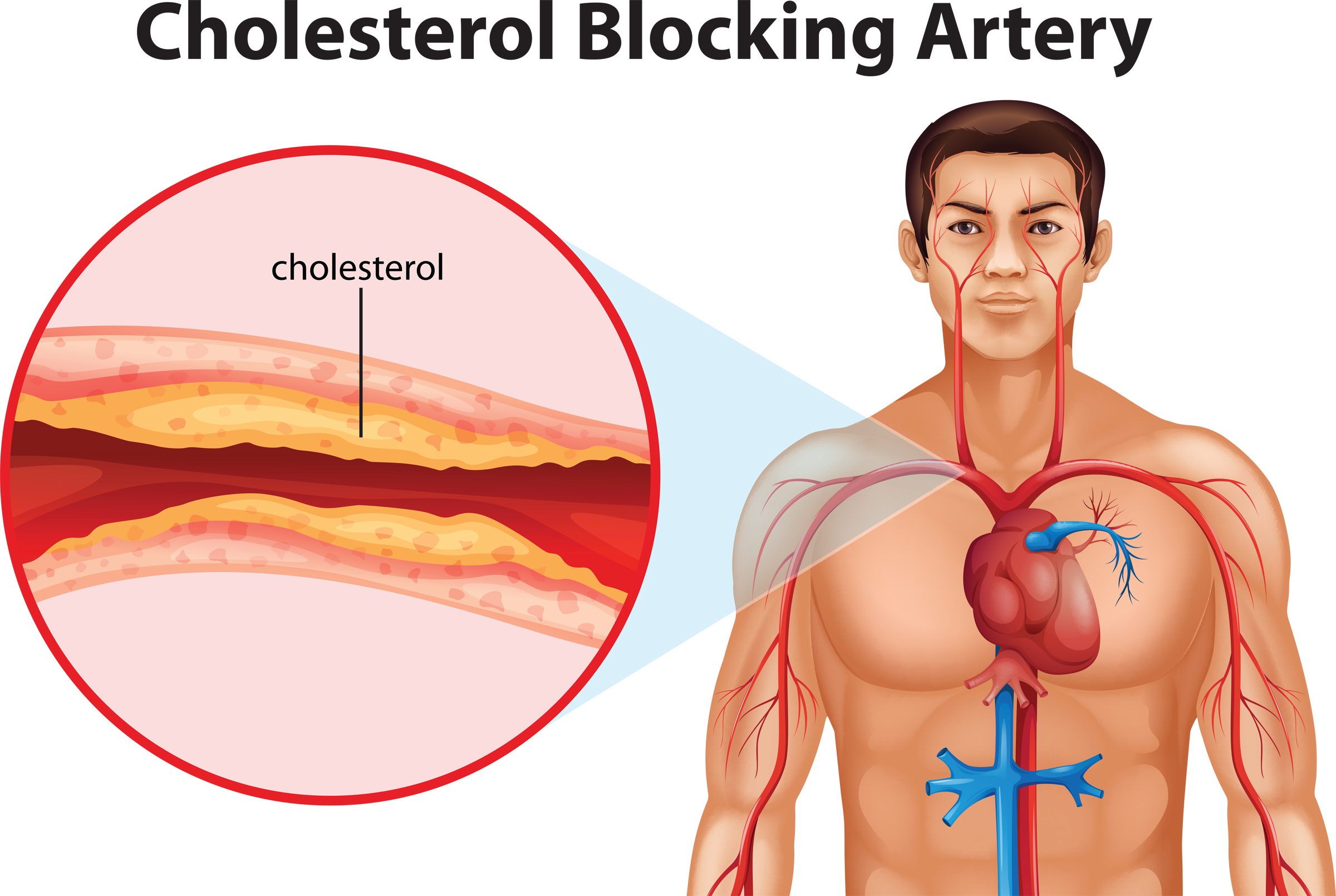 Subir colesterol
